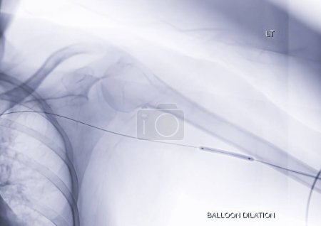 Téléchargez les photos : Angioplastie, angioplastie du ballon et angioplastie transluminale percutanée (ATP) sur le bras gauche. - en image libre de droit