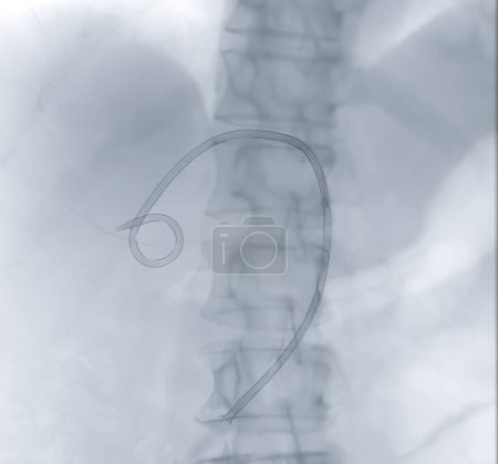 Téléchargez les photos : Image radiographique du cathéter dans le haut-ventre. - en image libre de droit