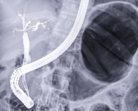 Téléchargez les photos : Image par rayons X de l'endoscopie après que le médecin ait pratiqué l'ERCP et la cholécystectomie laparoscopique dans la salle d'opération moderne. - en image libre de droit