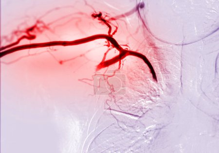 Foto de Imagen de angioplastia, angioplastia con balón y angioplastia transluminal percutánea (ATP)) . - Imagen libre de derechos