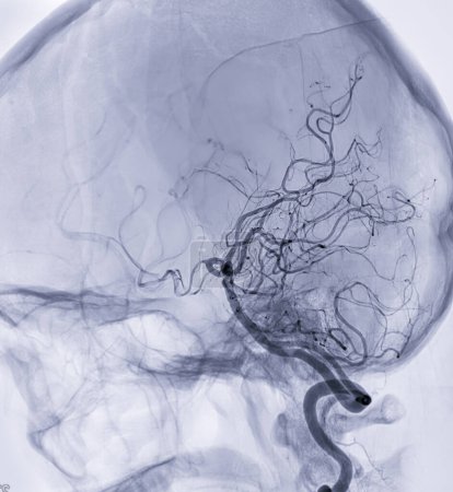 Téléchargez les photos : Angiographie cérébrale imageou artère cérébrale postérieure de la fluoroscopie en radiologie d'intervention montrant l'artère cérébrale. - en image libre de droit