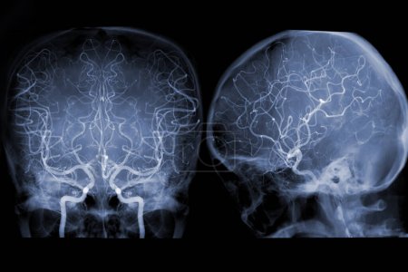 Téléchargez les photos : Cerebral angiography  image from Fluoroscopy in intervention radiology  showing cerebral artery. - en image libre de droit