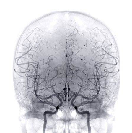 Foto de Cerebral angiography  image from Fluoroscopy in intervention radiology  showing cerebral artery. - Imagen libre de derechos
