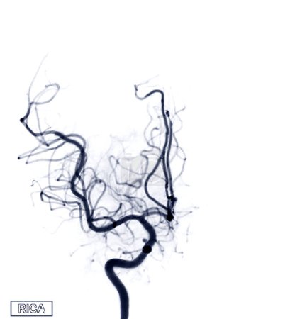 Téléchargez les photos : Image d'angiographie cérébrale du RICA par fluoroscopie en radiologie d'intervention montrant l'artère cérébrale. - en image libre de droit