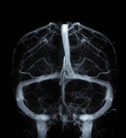 Foto de Venografías cerebrales para el diagnóstico Trombosis venosa cerebral - Imagen libre de derechos