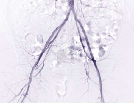Foto de Angiografía o angiografía de la arteria femoral - Imagen libre de derechos