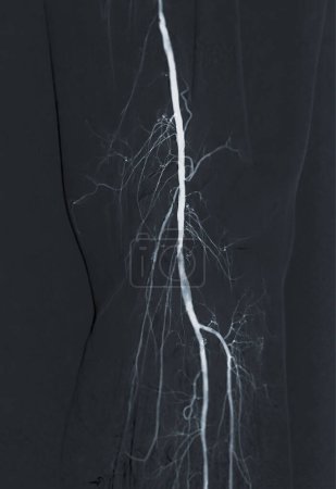 Photo for Femoral artery angiogram or angiography - Royalty Free Image