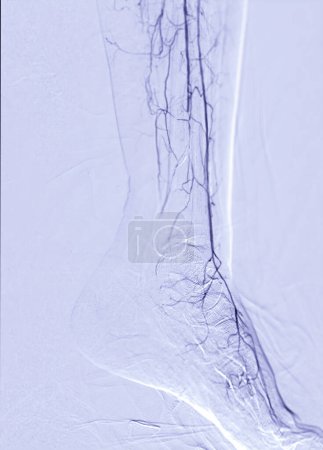 Foto de Angiografía de la arteria femoral o angiografía en el área de la extremidad inferior. - Imagen libre de derechos