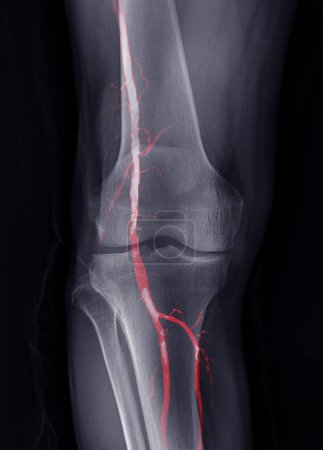 Photo for X-ray image of knee joint Fusion  with CTA Femoral run off . - Royalty Free Image