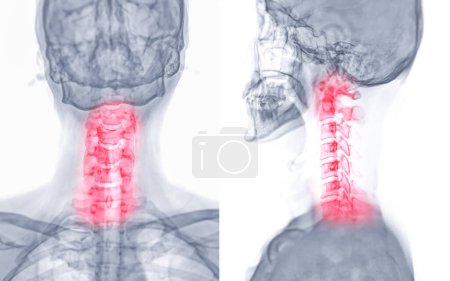 Foto de Radiografía de columna C o radiografía de la columna cervical AP y vista lateral para diagnóstico de hernia discal intervertebral, espondilosis y fractura. - Imagen libre de derechos