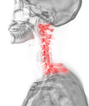 Photo for X-ray C-spine or x-ray image of Cervical spine lateral view for diagnostic intervertebral disc herniation ,Spondylosis and fracture. - Royalty Free Image