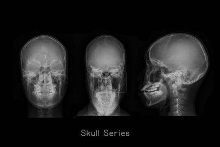 Foto de Imagen de rayos X del cráneo AP, vista de pueblo y lateral o serie de cráneos para el diagnóstico fractura de cráneo aislada sobre fondo negro. - Imagen libre de derechos