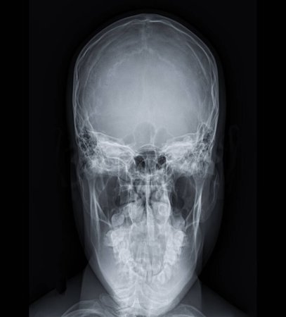Foto de Imagen de rayos X de la vista de la ciudad de Human Skull para el diagnóstico de fractura de cráneo aislada en Black Background. - Imagen libre de derechos