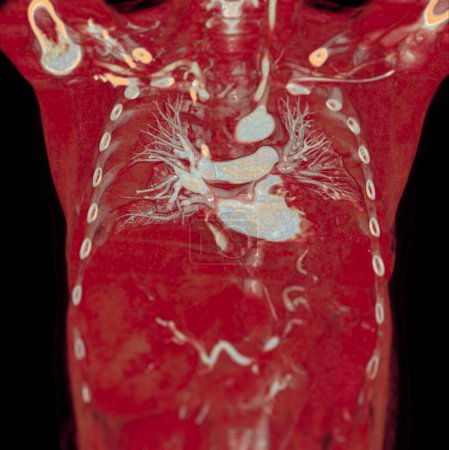 Téléchargez les photos : CTA artères pulmonaires rendu 3D montrant la branche de l'artère pulmonaire - en image libre de droit