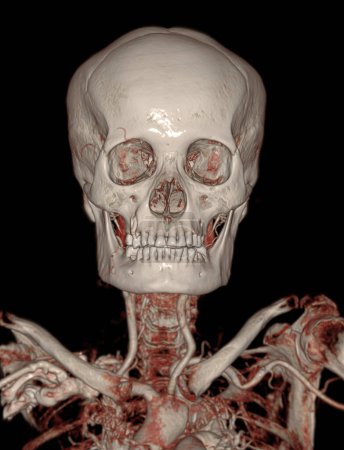 Foto de CTA angiografía cerebral y de la arteria carótida o TC del cerebro Imagen de representación 3D . - Imagen libre de derechos