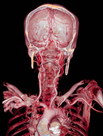 Foto de CTA angiografía cerebral y de la arteria carótida o TC del cerebro Imagen de representación 3D . - Imagen libre de derechos