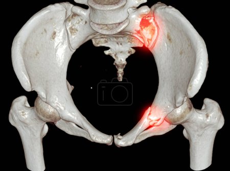 CT Scan Beckenknochen mit beiden Hüftgelenken 3D Rendering zeigt Kreuzbeinfraktur und Superior Schambein Rumus.