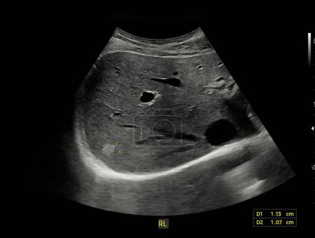Photo for Ultrasound upper abdomen for diagnosis abdominal pain. - Royalty Free Image