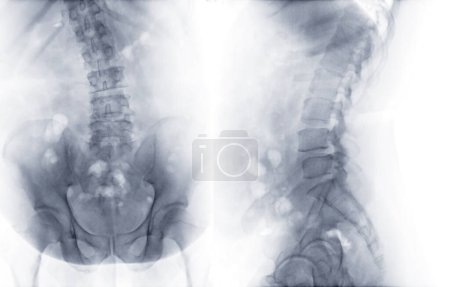 Foto de Imagen de rayos X de columna lumbar o columna L-s AP y vista lateral para diagnóstico de dolor lumbar. - Imagen libre de derechos