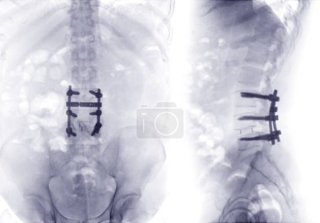 Foto de Imagen de rayos X de columna lumbar o columna L-s AP y vista lateral Placas lumbares fijas postoperatorias y tornillo. - Imagen libre de derechos