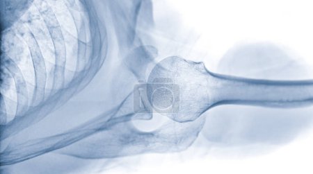 Téléchargez les photos : X-ray Épaule articulaire vue transaxillaire de l'épaule pour le diagnostic fracture de l'articulation de l'épaule
. - en image libre de droit