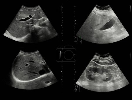 Photo for Ultrasound upper abdomen for diagnosis abdominal pain. - Royalty Free Image