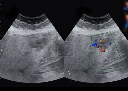 Téléchargez les photos : Échographie abdomen supérieur pour le diagnostic des douleurs abdominales. - en image libre de droit