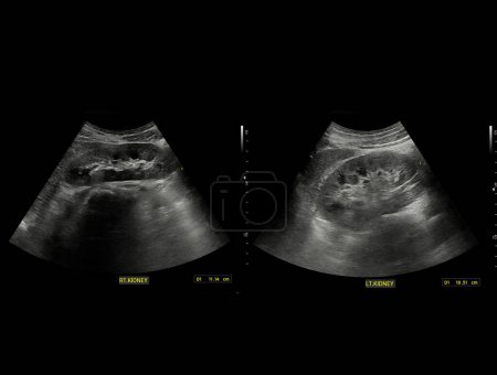 Foto de Ultrasonido de riñón o KUB para la detección de la enfermedad de cálculos renales o urolitiasis. - Imagen libre de derechos