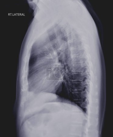 Photo for Chest X-ray or X-Ray Image of Human Lung Lateral View with full inspiration for detect heart disease and lung disease . check up concept. - Royalty Free Image