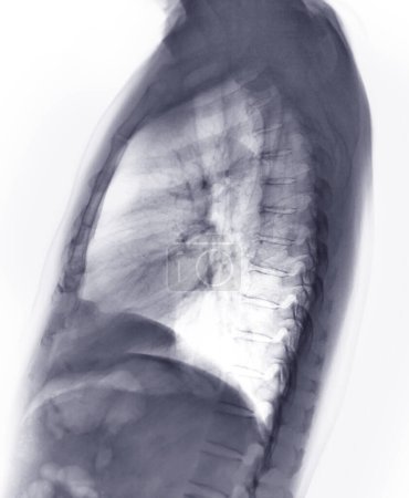 Photo for Chest X-ray or X-Ray Image of Human Lung Lateral View with full inspiration for detect heart disease and lung disease . check up concept. - Royalty Free Image