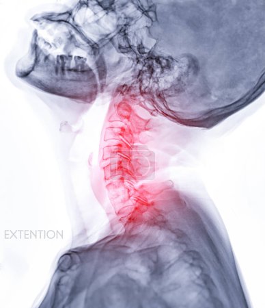 Photo for X-ray C-spine or x-ray image of Cervical spine  Extension viewfor diagnostic intervertebral disc herniation ,Spondylosis and fracture. - Royalty Free Image