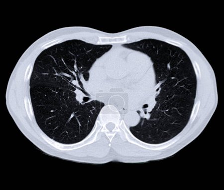 Photo for CT scan of Chest or lung for screening lung nodules and lung cancer . - Royalty Free Image