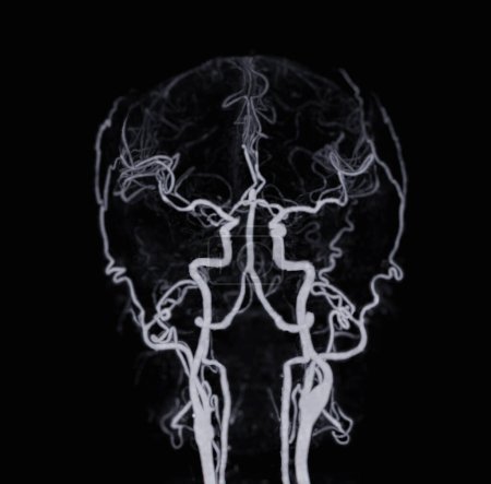 Foto de Angiografía por TC del cerebro o ATC que muestra la arteria cerebral. - Imagen libre de derechos