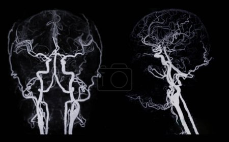 Photo for CT angiography of the brain or CTA brain showing Cerebral artery. - Royalty Free Image