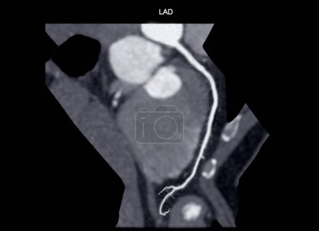Photo for CTA coronary artery Curve refomation showing left coronary artery . - Royalty Free Image