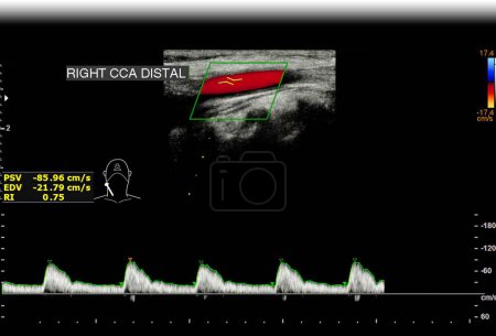 A carotid artery Doppler ultrasound is a diagnostic test the arteries in the neck for diagnosis  any blockage in the veins by a blood clot or thrombus formation.