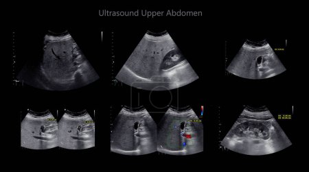Téléchargez les photos : Ultrasound upper abdomen showing  Liver and gall bladder for screening hepatic cell carcinoma and gallstone. - en image libre de droit