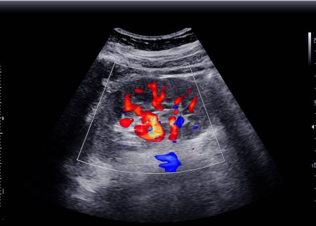 Foto de Ultrasonido de riñón o KUB para la detección de la enfermedad de cálculos renales. - Imagen libre de derechos