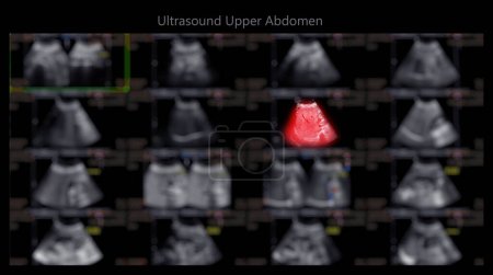 Téléchargez les photos : Ultrasound upper abdomen showing  Liver and gall bladder for screening hepatic cell carcinoma and gallstone. - en image libre de droit