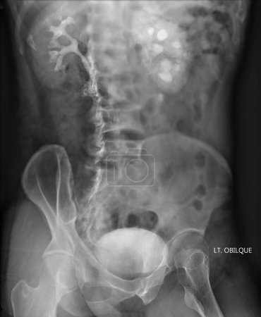 Photo for Intravenous pyelogram or I.V.P is an X-ray exam of urinary tract after injection contrast media agent  . - Royalty Free Image