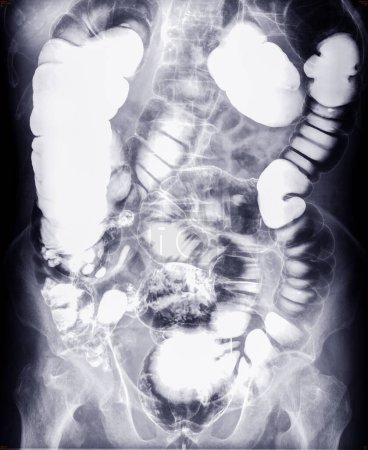 Photo for Barium enema study image or x-ray image of large intestine . - Royalty Free Image