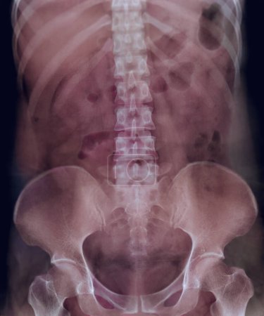 Foto de El pielograma intravenoso o I.V.P es un examen de rayos X del tracto urinario después del medio de contraste por inyección.  . - Imagen libre de derechos