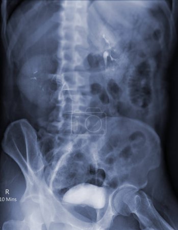 Photo for Intravenous pyelogram or I.V.P is an X-ray exam of urinary tract after injection contrast media agent  . - Royalty Free Image