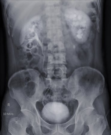 Foto de El pielograma intravenoso o I.V.P es un examen de rayos X del tracto urinario después del medio de contraste por inyección.  . - Imagen libre de derechos