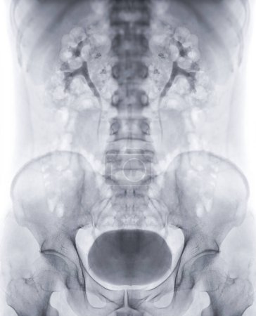 Photo for Intravenous pyelogram or I.V.P is an X-ray exam of urinary tract after injection contrast media agent showing full bladder. - Royalty Free Image
