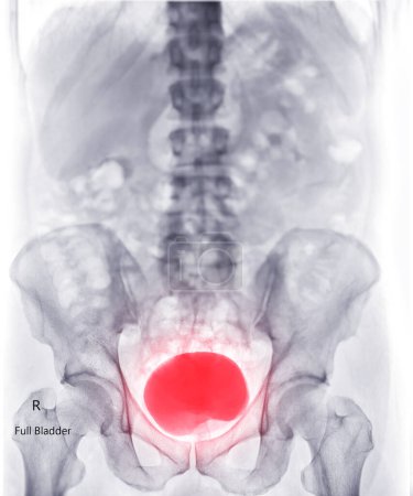 Photo for Intravenous pyelogram or I.V.P is an X-ray exam of urinary tract after injection contrast media agent showing full bladder. - Royalty Free Image