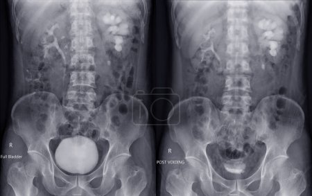 Photo for Intravenous pyelogram or I.V.P is an X-ray exam of urinary tract after injection contrast media agent  compare full bladder and post void. - Royalty Free Image