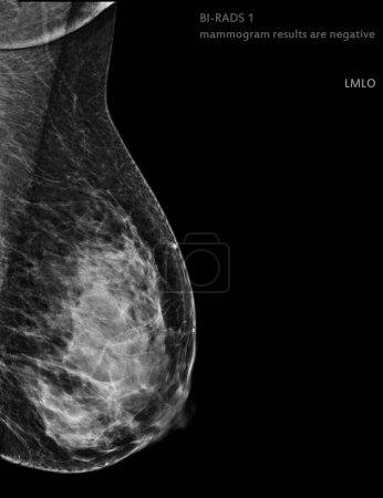 Téléchargez les photos : Mammographie numérique à rayons X Vue MLO côté droit. mammographie ou scanner du sein pour le cancer du sein Les résultats de la mammographie BI-RADS 1 sont négatifs. - en image libre de droit