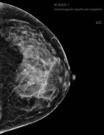 Photo for X-ray Digital Mammogram Right side CC view . mammography or breast scan for Breast cancer BI-RADS 1 mammogram results are negative. - Royalty Free Image