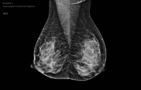 Photo for X-ray Digital Mammogram of both  side MLO view . mammography or breast scan for Breast cancer BI-RADS 1 mammogram results are negative. - Royalty Free Image
